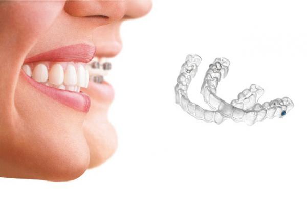 Invisalign